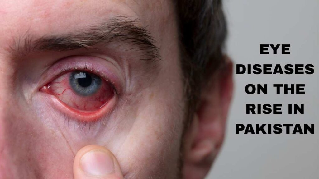 Eye Diseases on the Rise in Pakistan