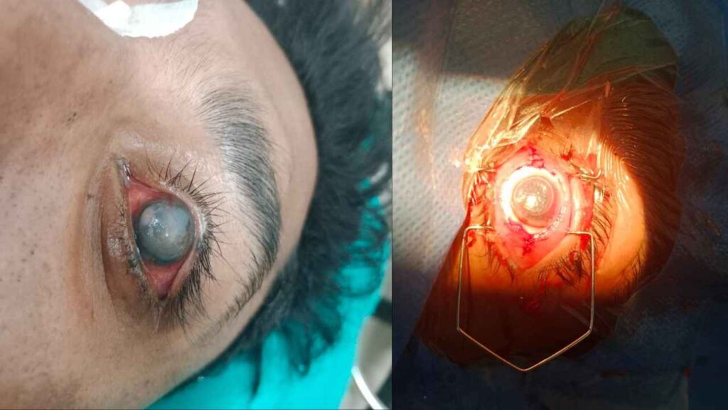 phaco or stitch-less cataract surgery