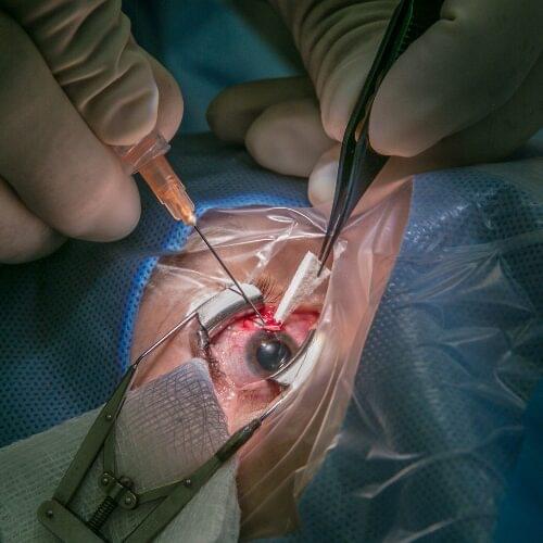 Cataract Surgery in Pakistan