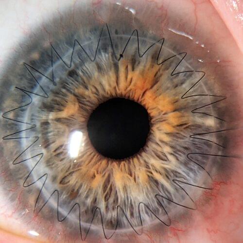 Cornea Transplant